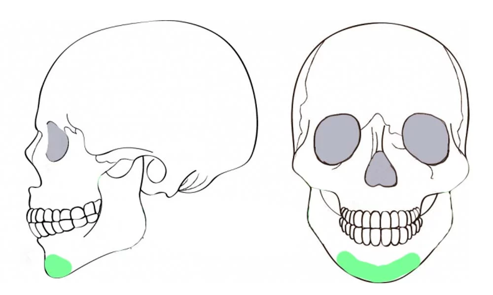 削骨手術 下顎骨