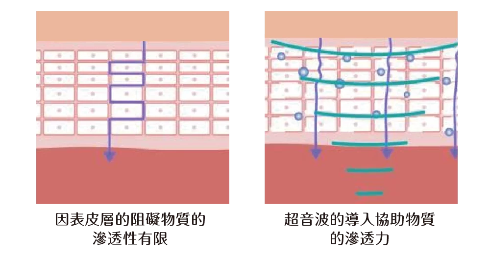 泡泡活氧 UltraSound