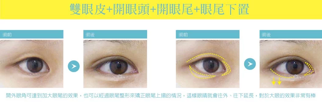 開眼頭眼尾 02 1