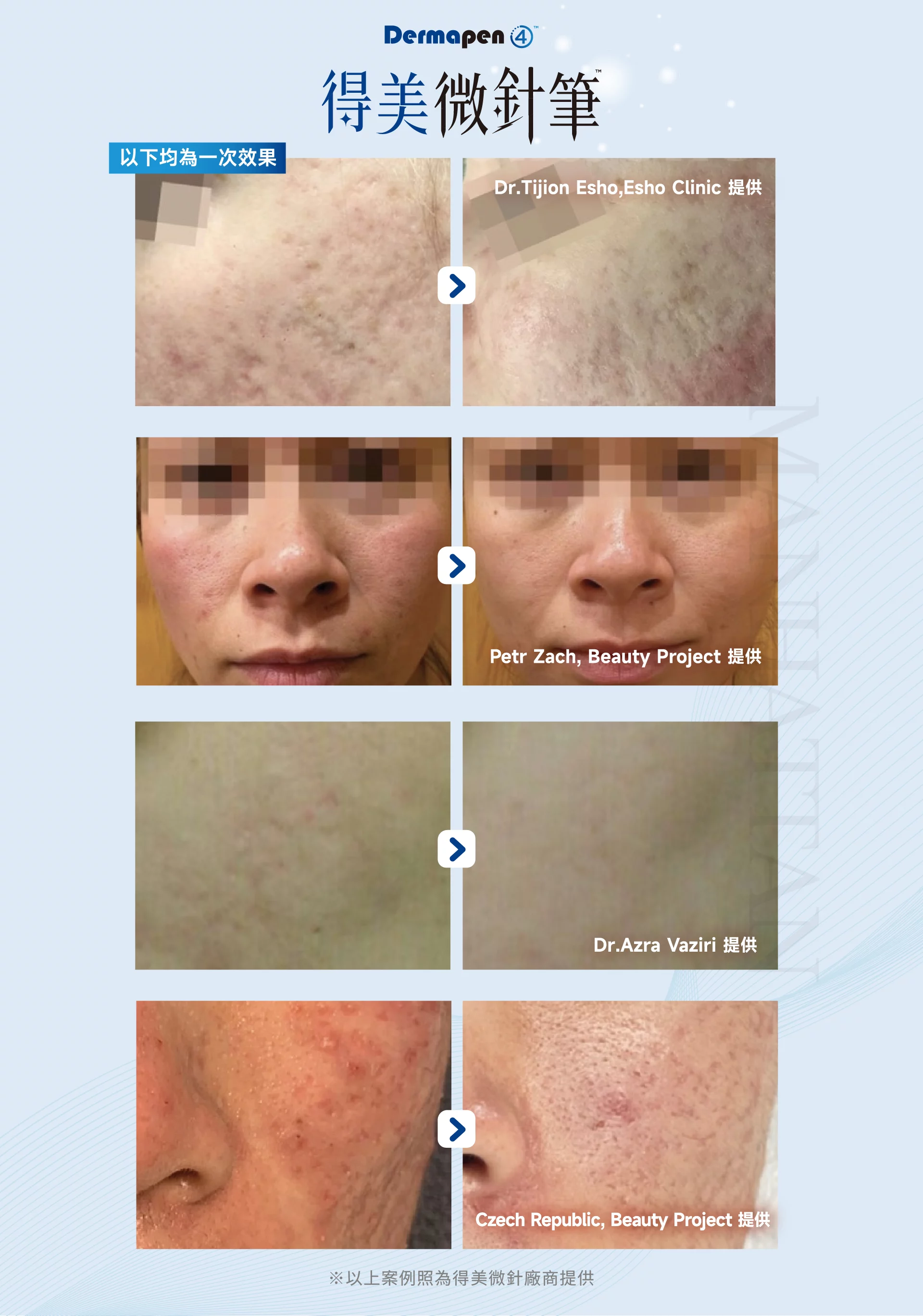 Dermapen得美微針 案例