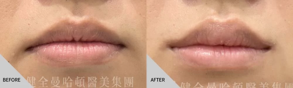 嘴角上揚 01 案例