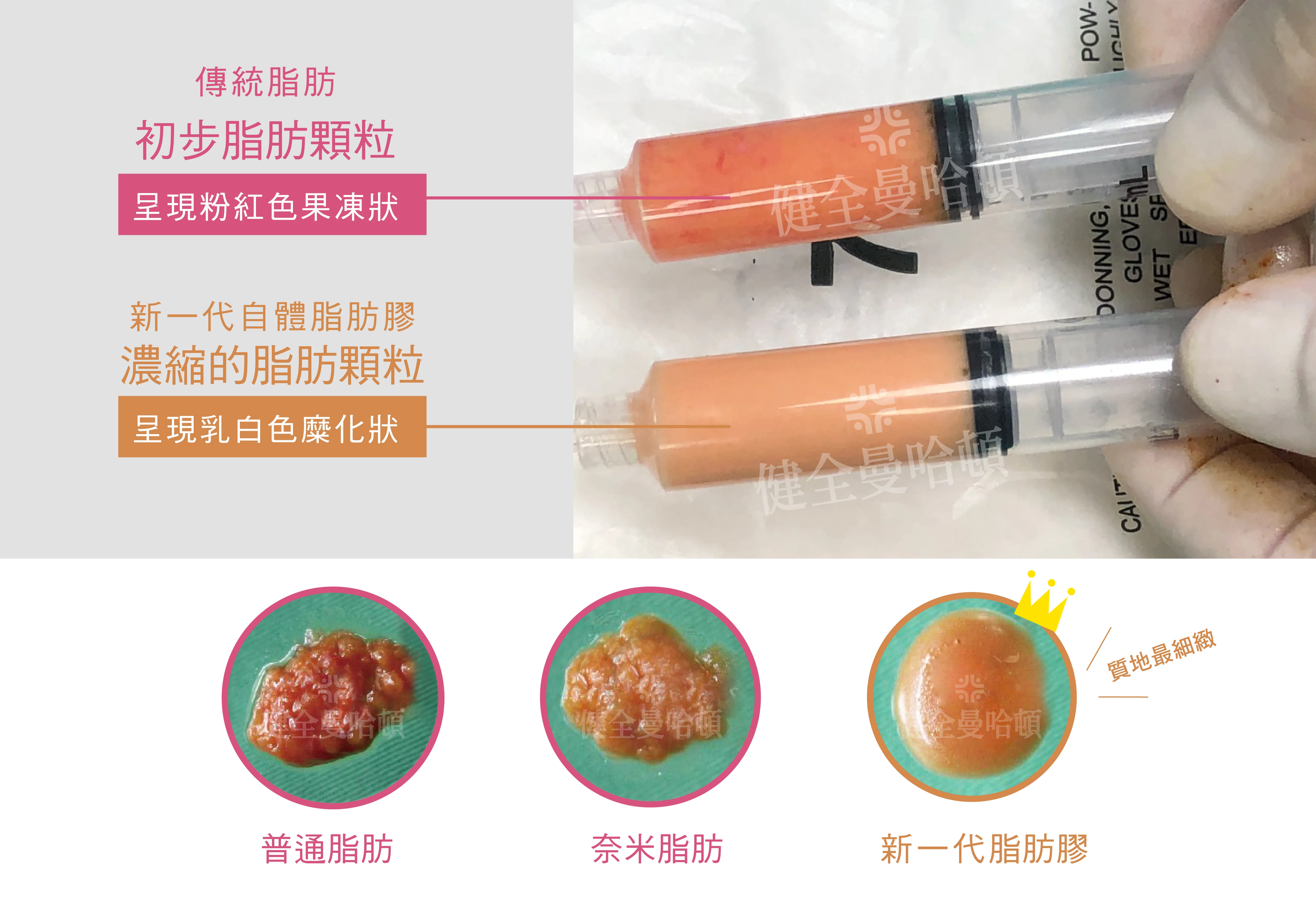 自體脂肪移植 04