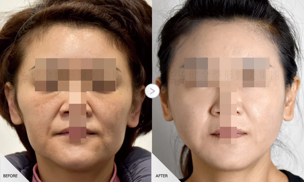 自體脂肪移植 案例 全臉補脂 03