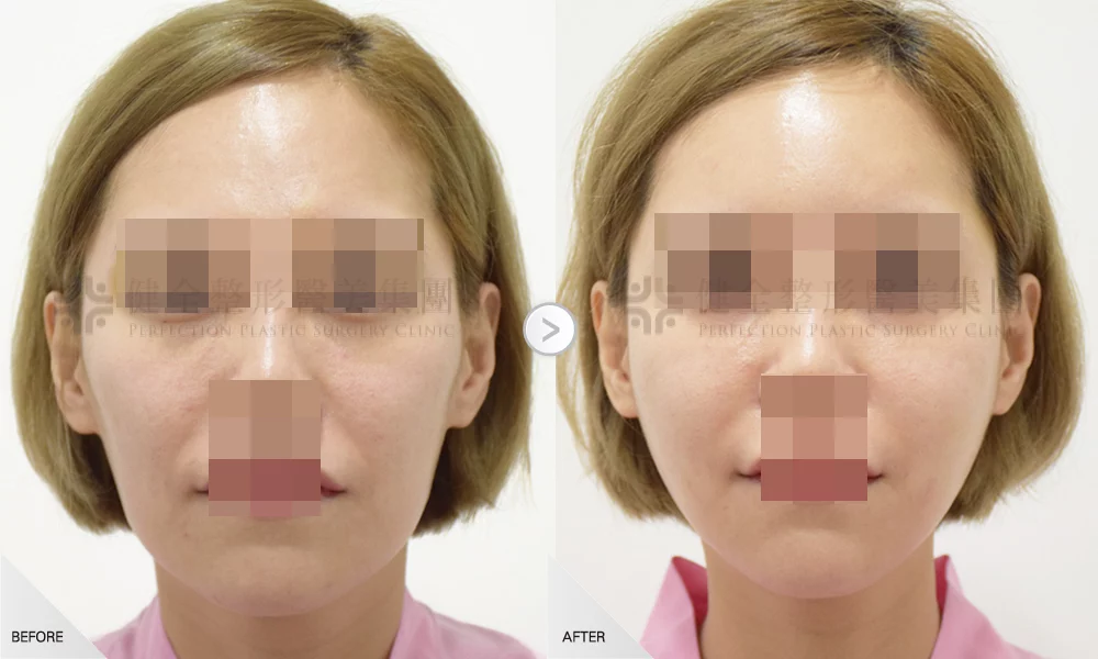 自體脂肪移植 案例 全臉補脂 05