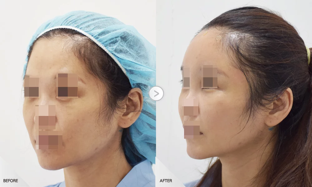 自體脂肪移植 案例 額頭太陽穴