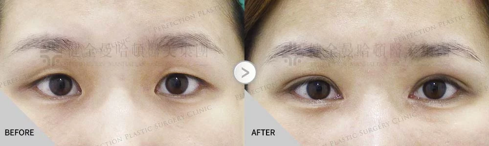 舊 余承穎 縫雙眼皮開眼頭