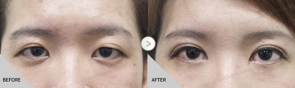 舊 楊禮霙（4.26）9.26 提眼瞼 開眼頭割双眼皮