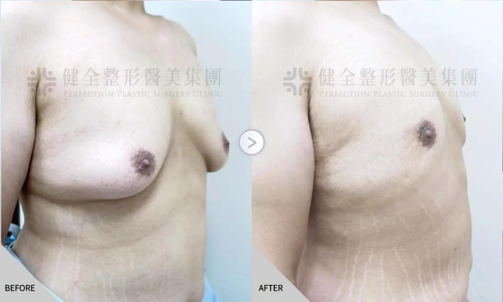 舊官網 男乳 乳腺脂肪內拉03