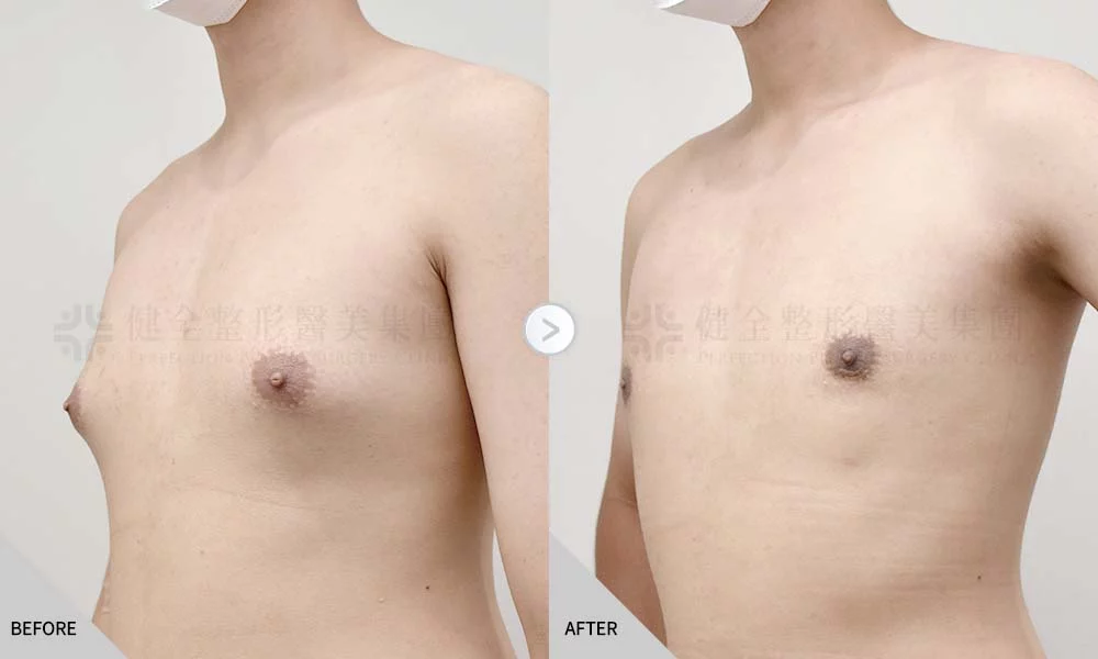 舊官網 男乳 乳腺脂肪型02