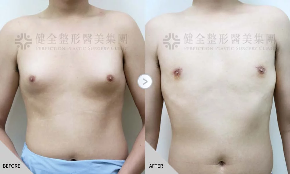 舊官網 男乳 脂肪型02