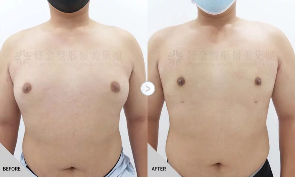 舊官網 男乳 脂肪型03