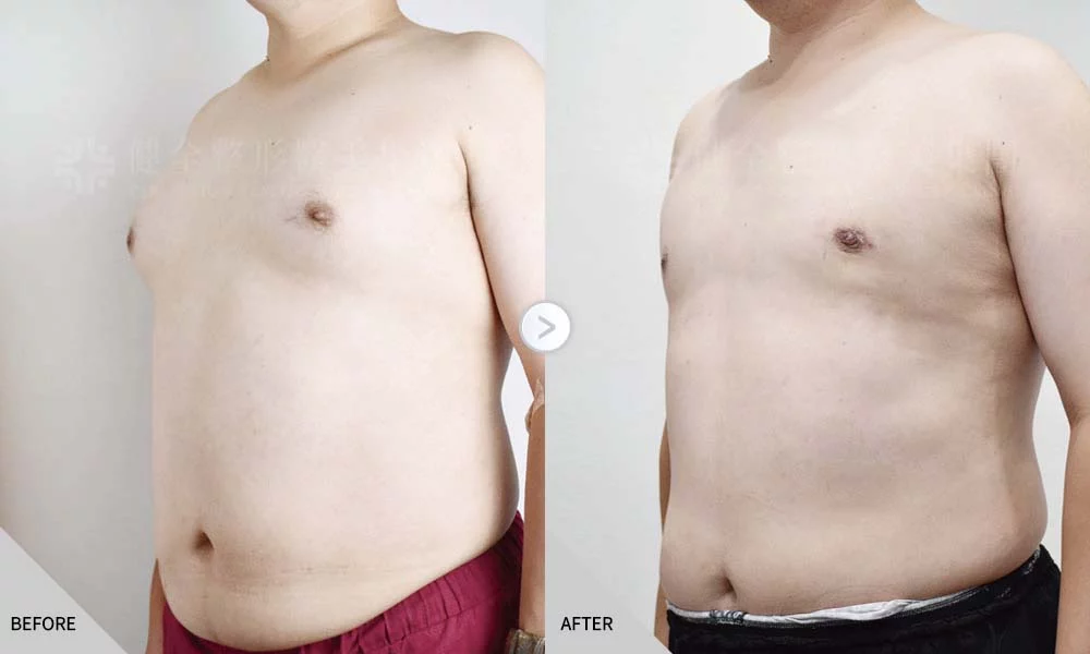 舊官網 男乳 脂肪型05