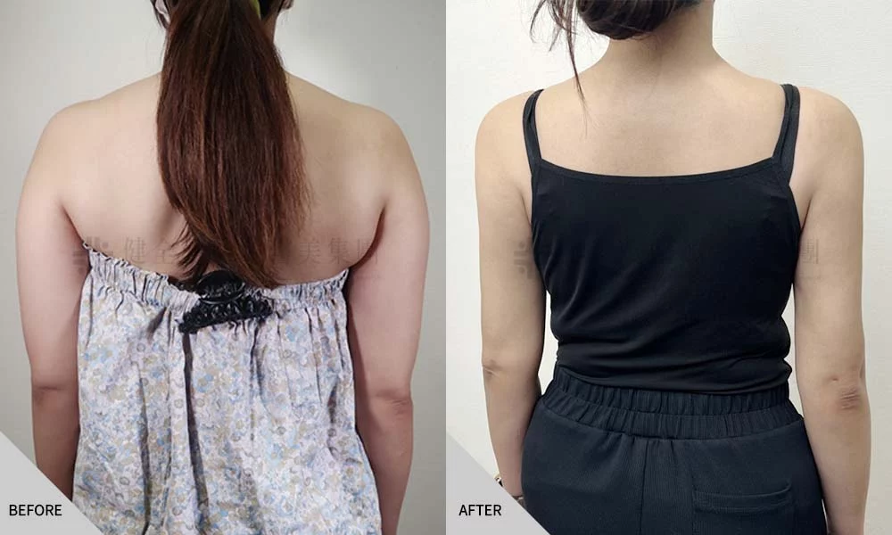 郭若潼 手臂抽脂 02