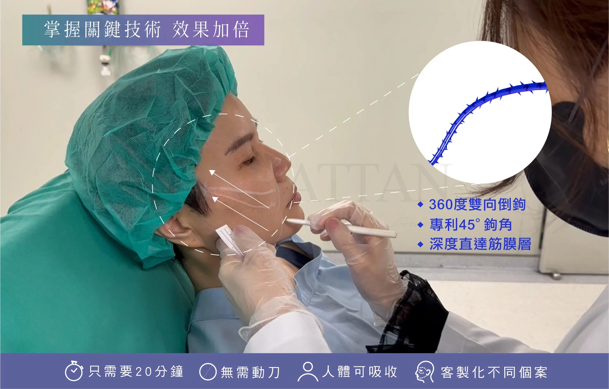 SMAS 筋膜隱痕拉提 03