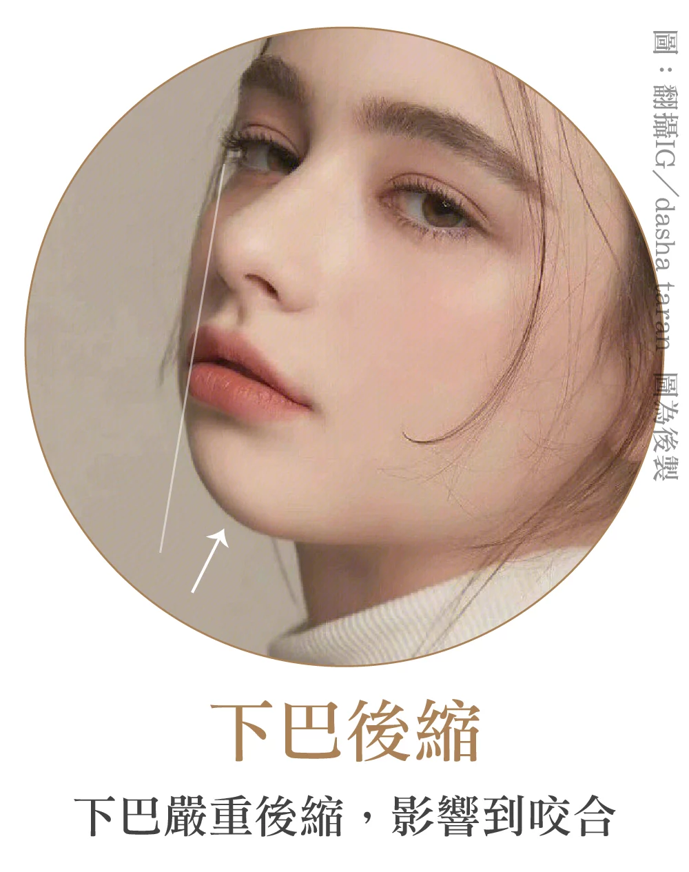 下巴精雕 下巴後縮 1