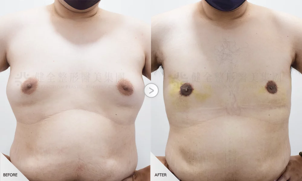 嚴重型 環拉乳暈3有銷像