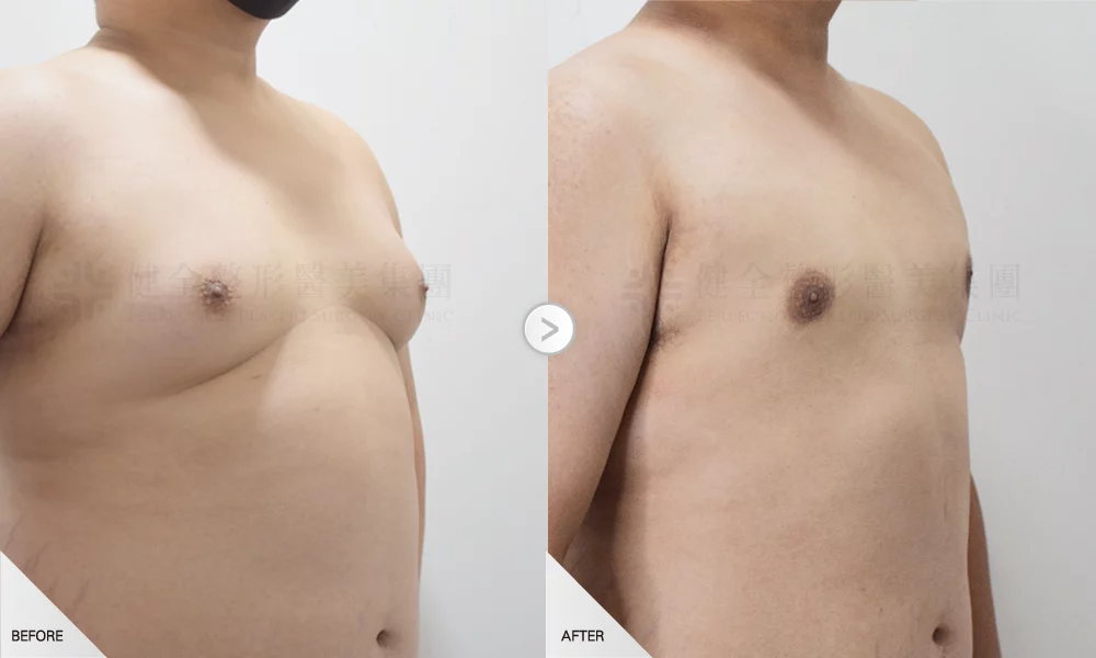 嚴重型 環拉乳暈7有銷像