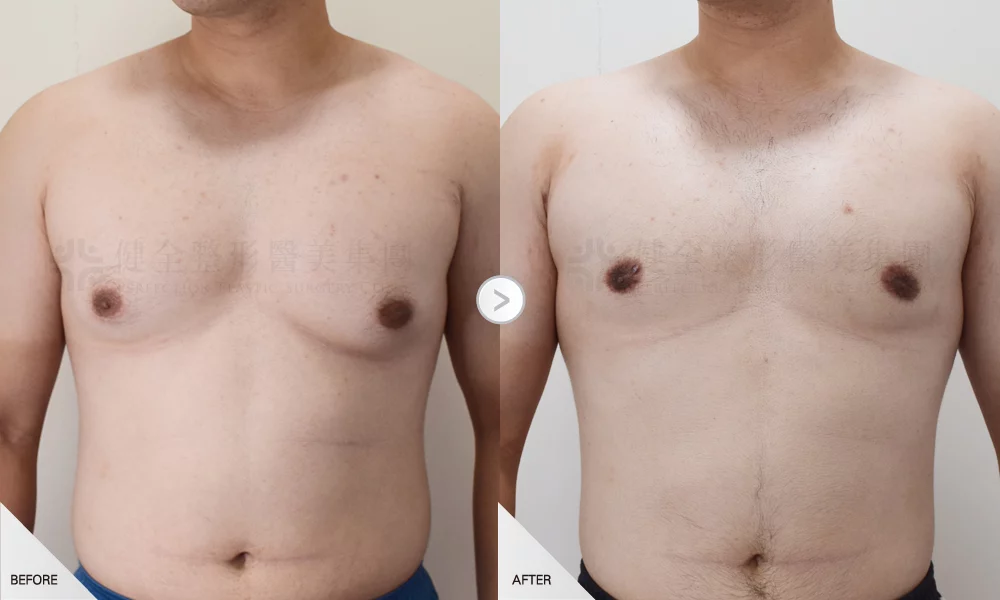 嚴重型 環拉乳暈有銷像