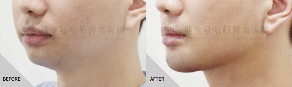 天鵝頸下巴 02