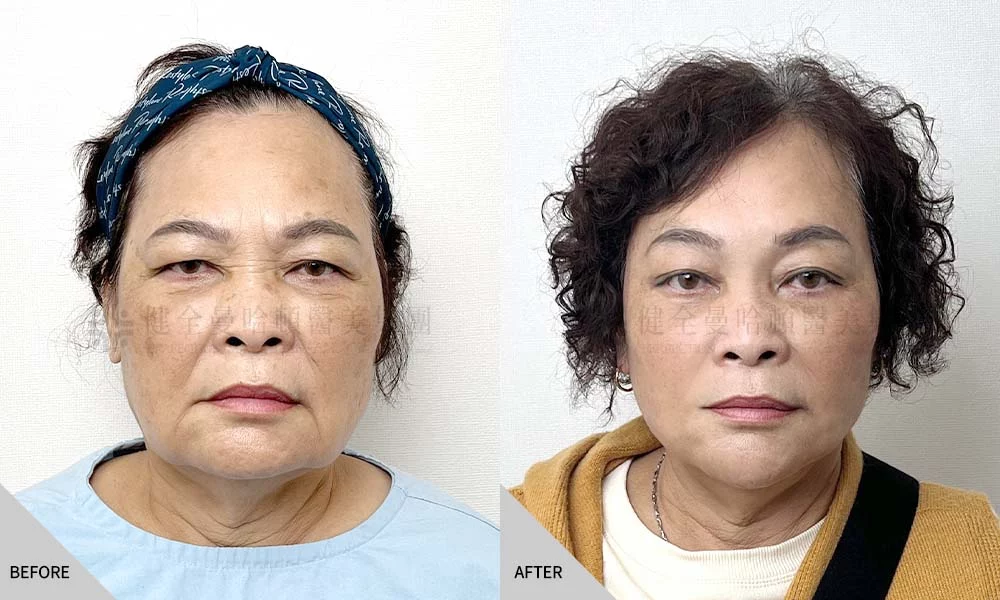 宋新蘭 全臉拉皮 01