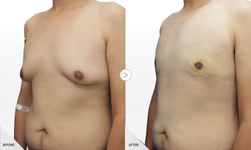 林立晟 男性女乳 環拉乳暈