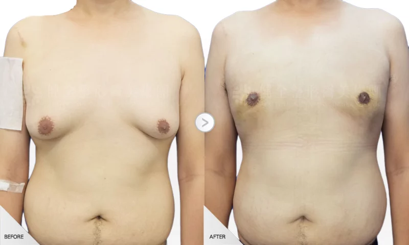 林立晟 男性女乳2 環拉乳暈