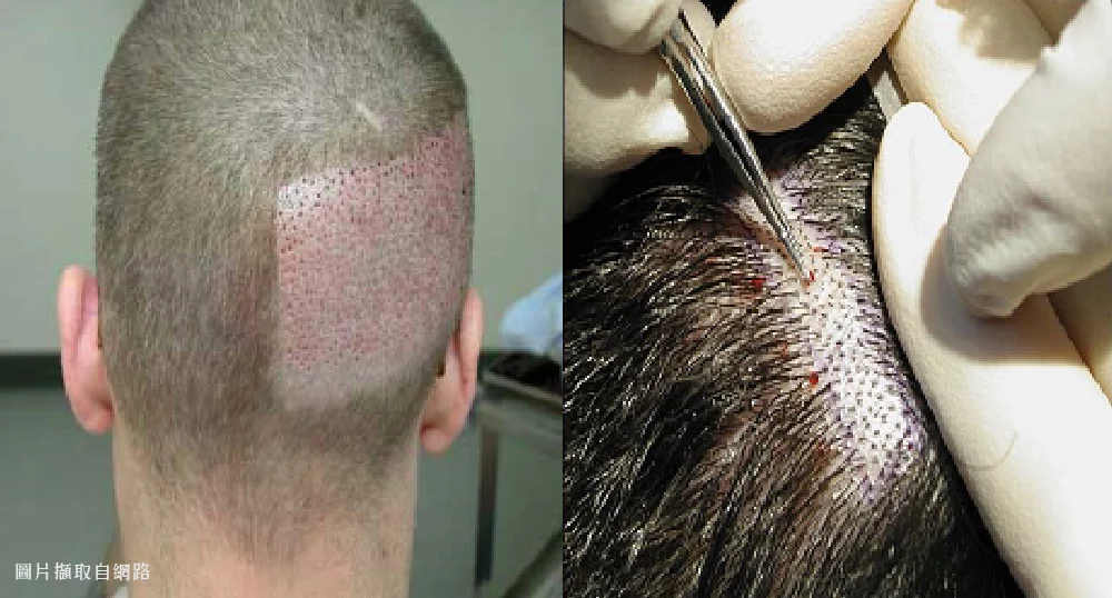 植髮 FUE 1