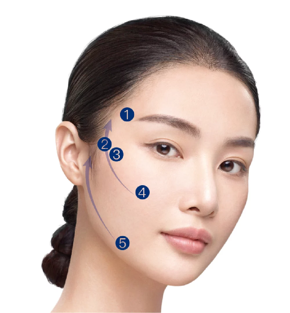 瑞斯朗玻尿酸 韌帶拉提注射部位