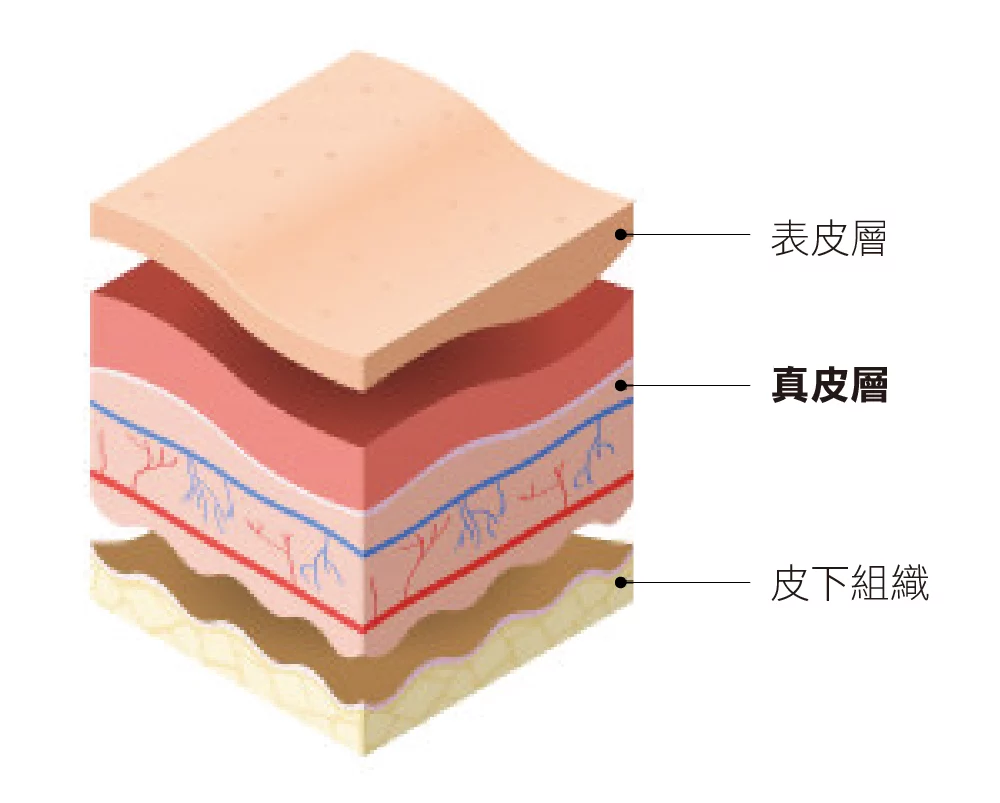 異體真皮粉 真皮