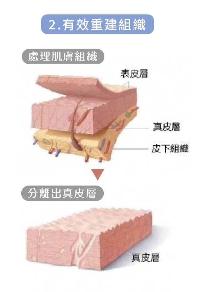 異體真皮粉 重建 