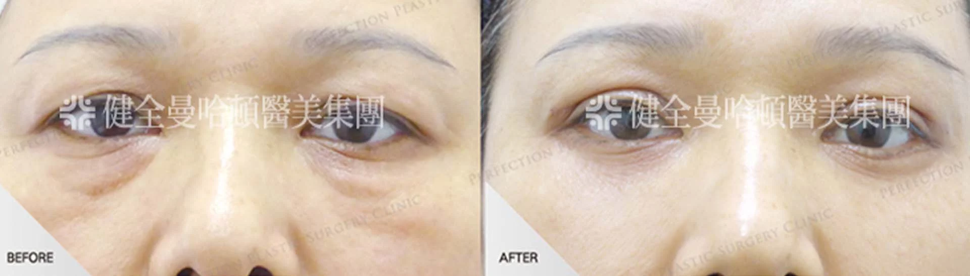 眼袋 混合型眼袋