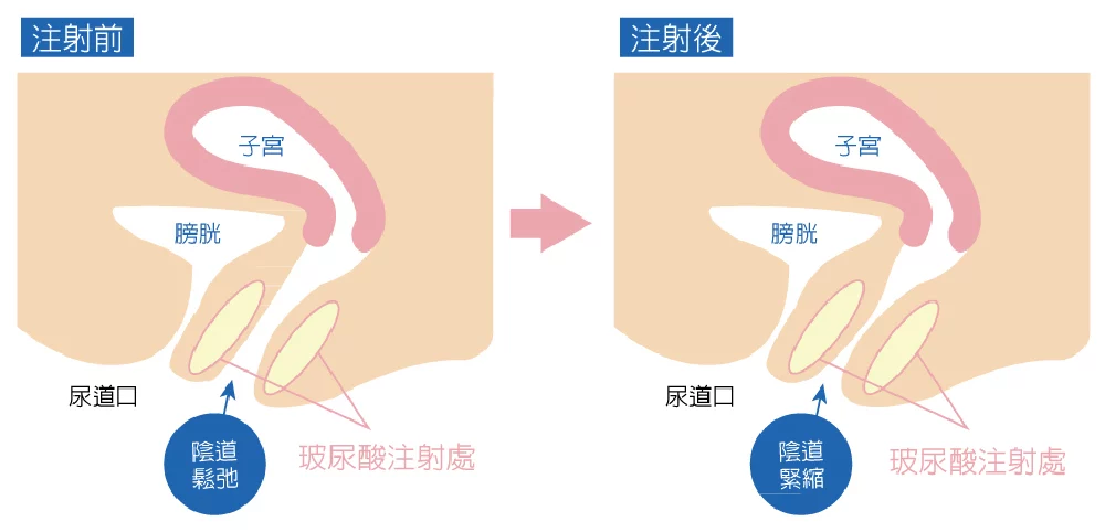 私密處美型 玻尿酸