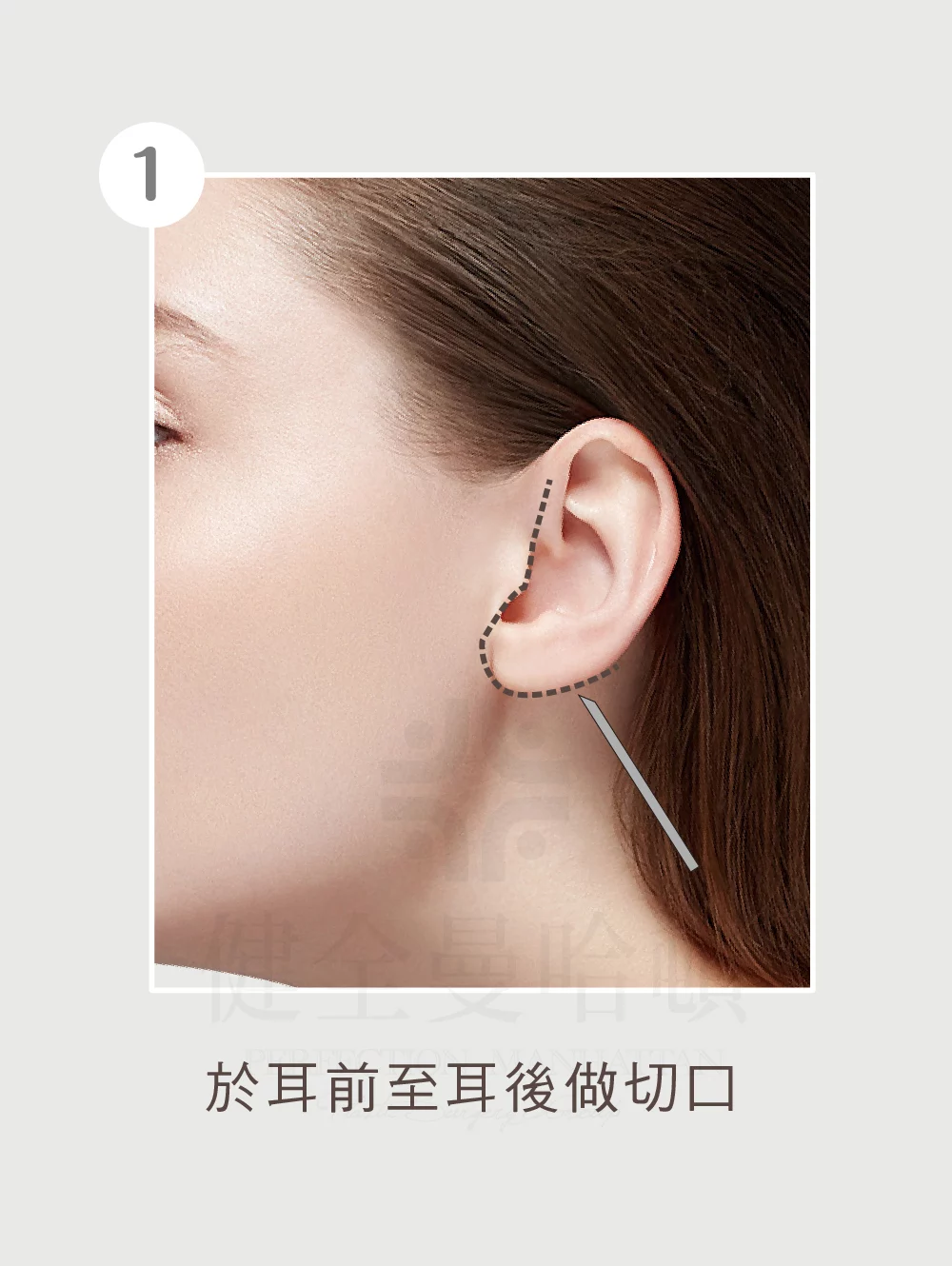 臉部拉皮手術 中下臉 01 