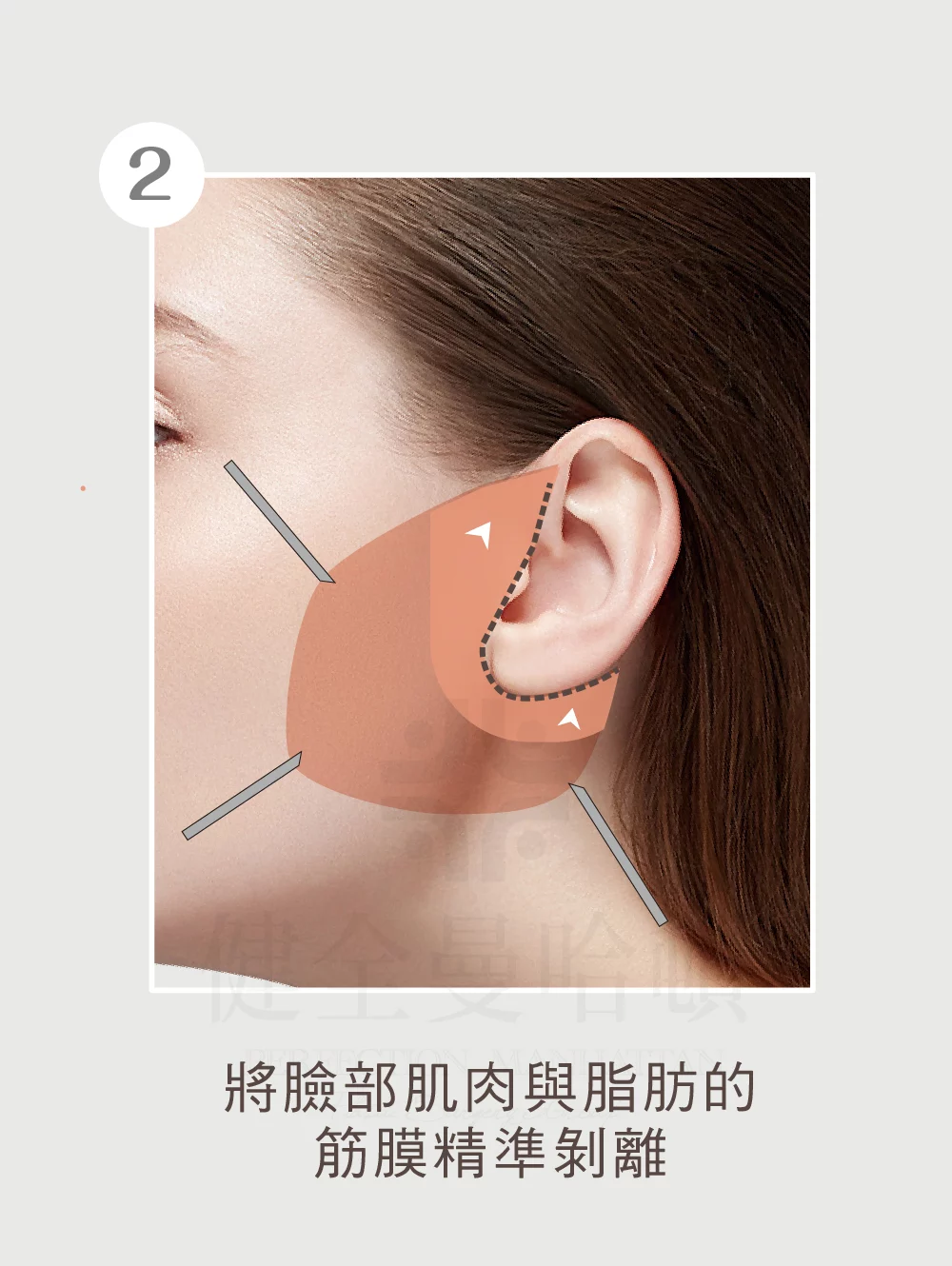 臉部拉皮手術 中下臉 02 