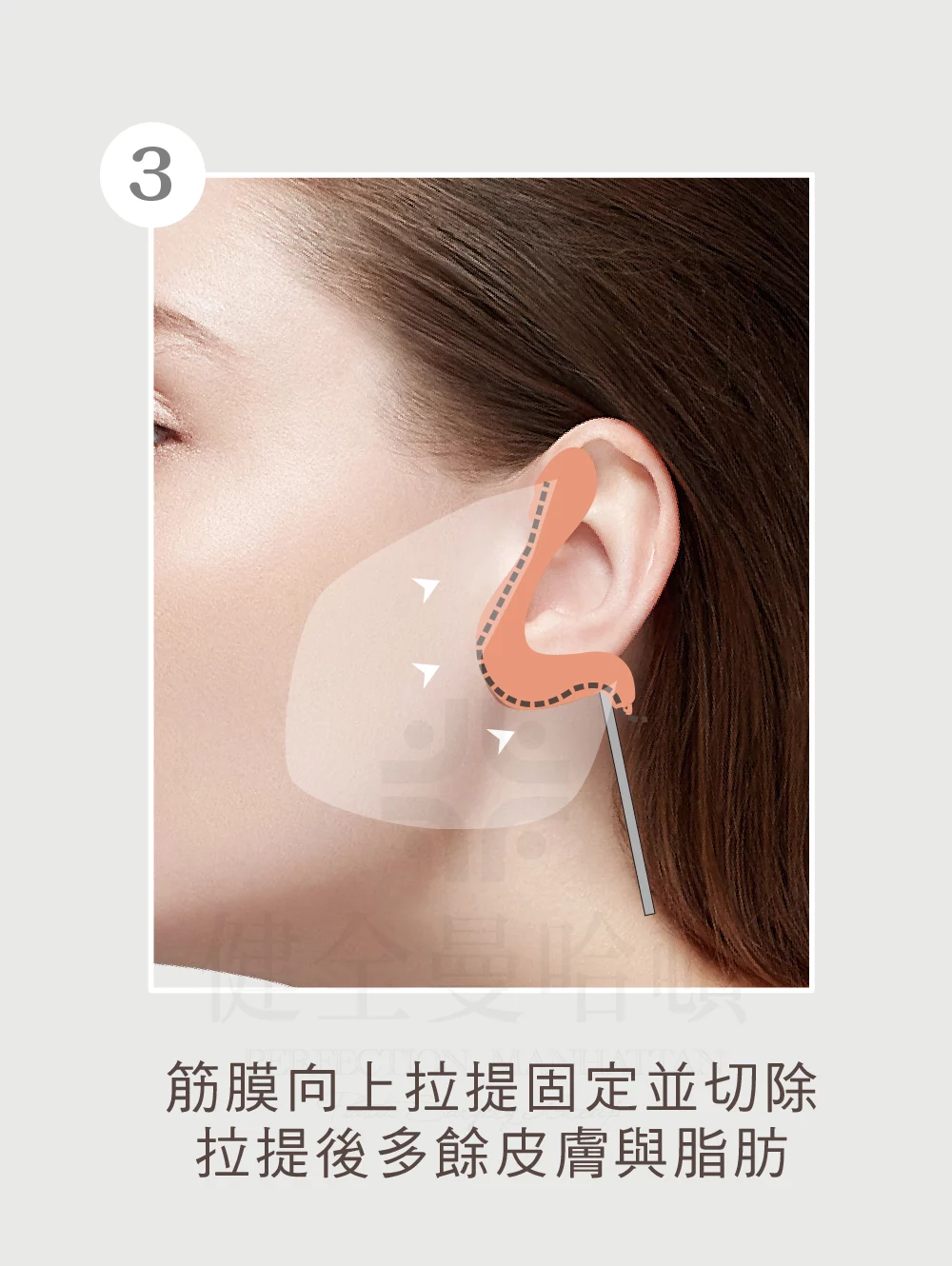 臉部拉皮手術 中下臉 03 