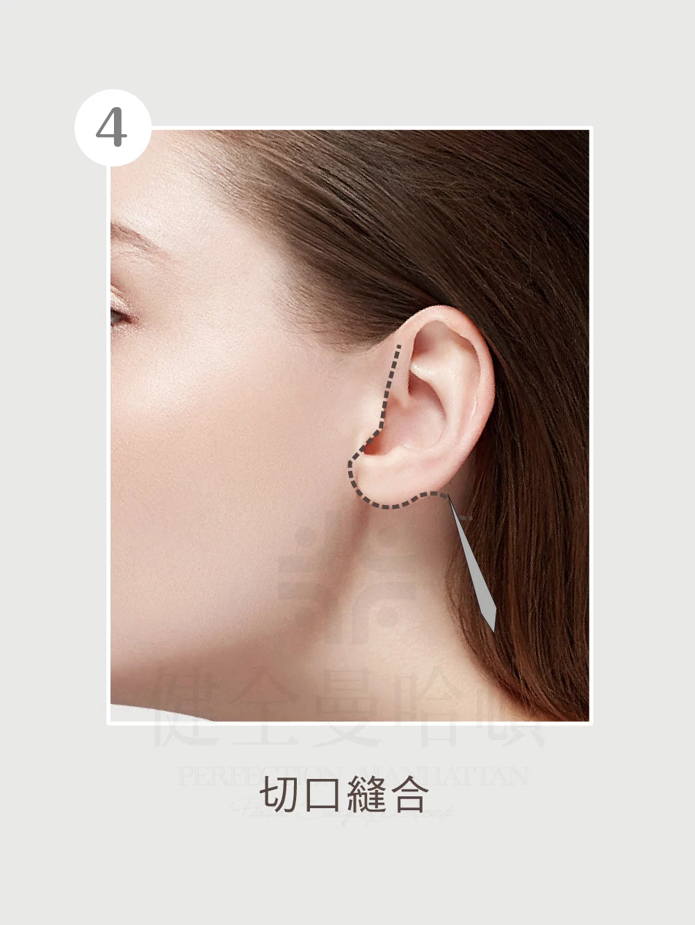 臉部拉皮手術 中下臉 04 