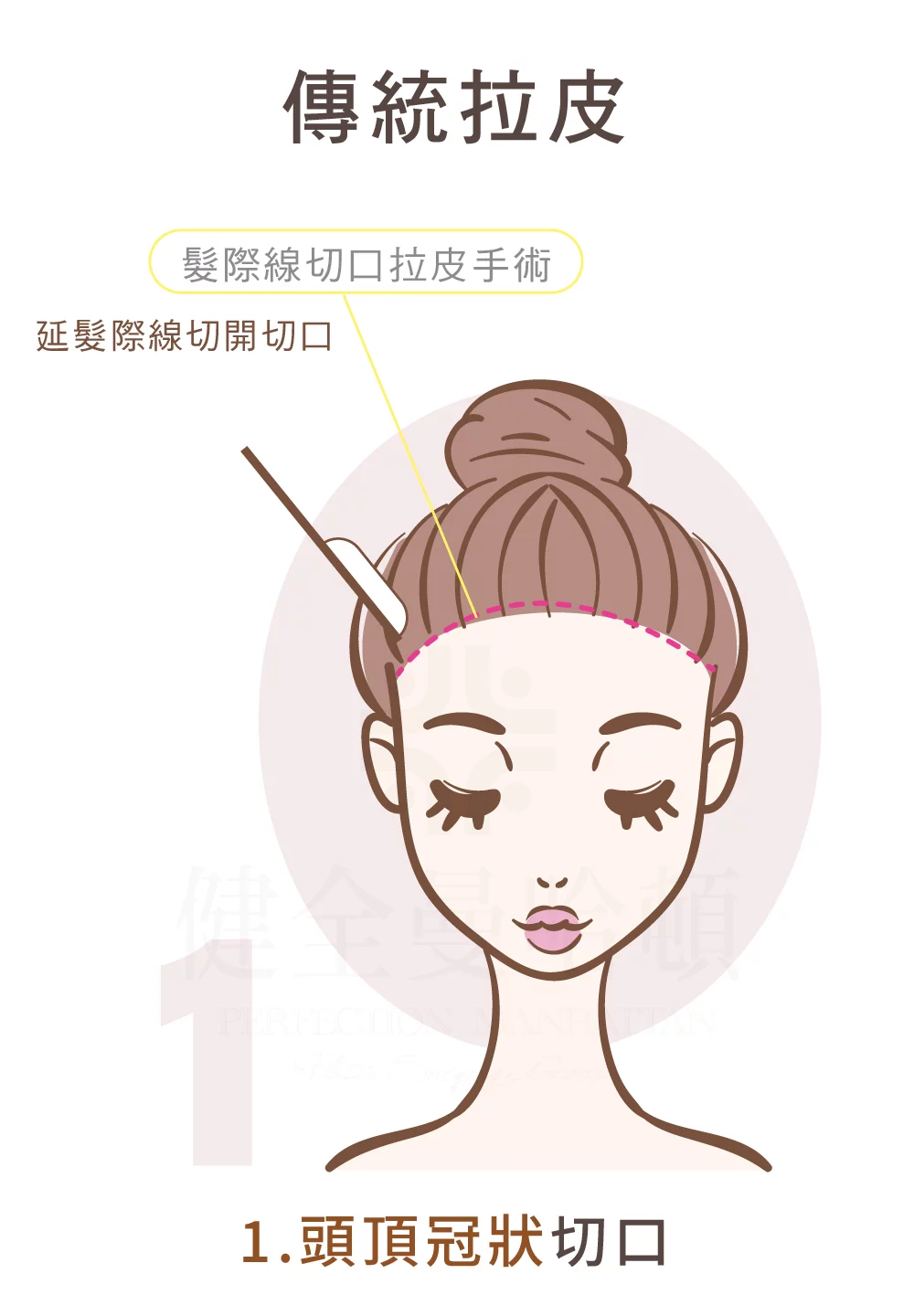 臉部拉皮手術 傳統拉皮 頭頂冠狀