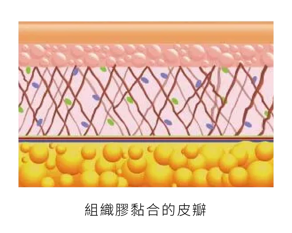 臉部拉皮手術 組織膠 02 
