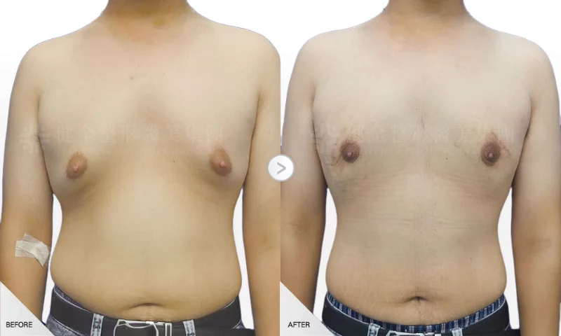 賴人瑞 男性女乳 一字