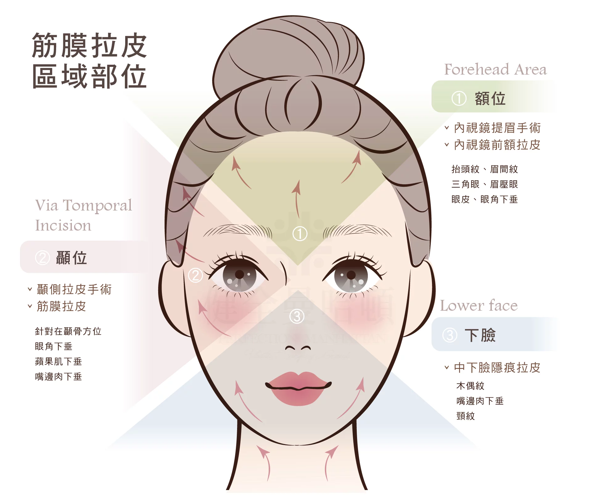 顳側拉皮 筋膜拉皮