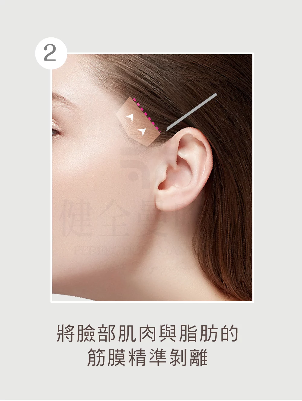 顳側拉皮 顳側 02