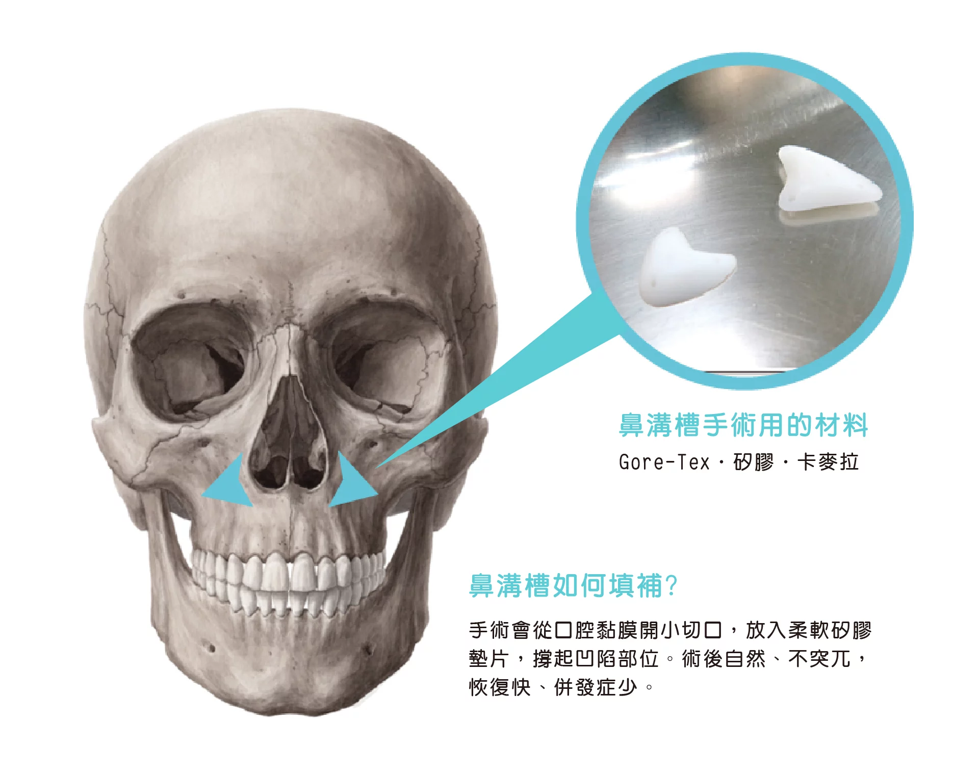 鼻溝槽 鼻溝槽 04