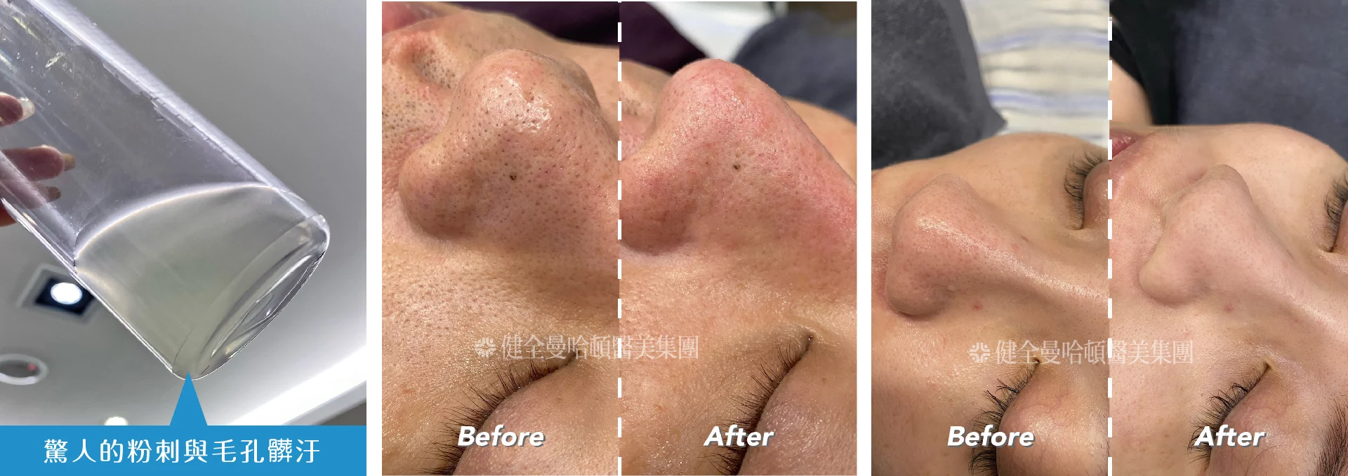 海菲秀 療程後 3